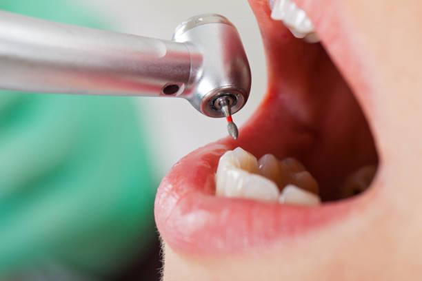 Trusted IN Emergency Dental Service Experts